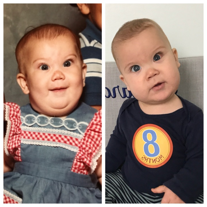 Stickler Syndrome Diagnosis – Our&nbsp;Story